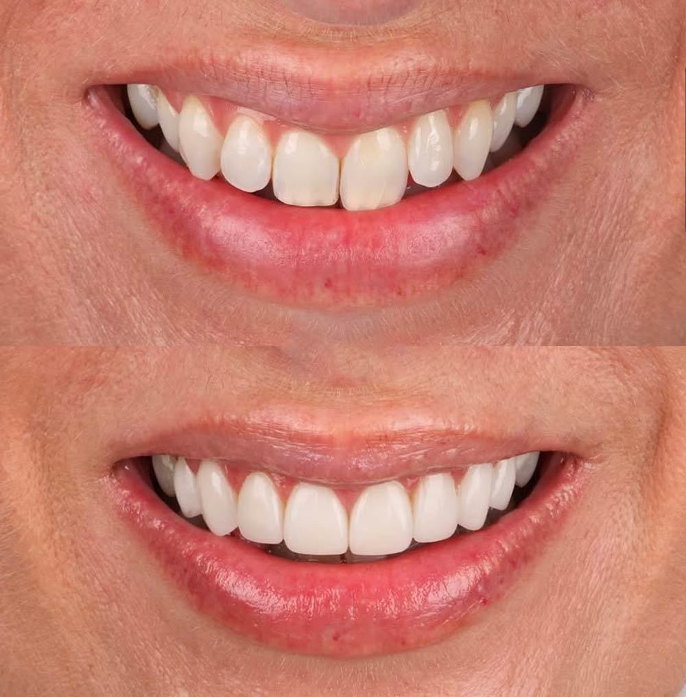 Latest company case about Before & After: Digital Smile Design with Porcelain Veneers