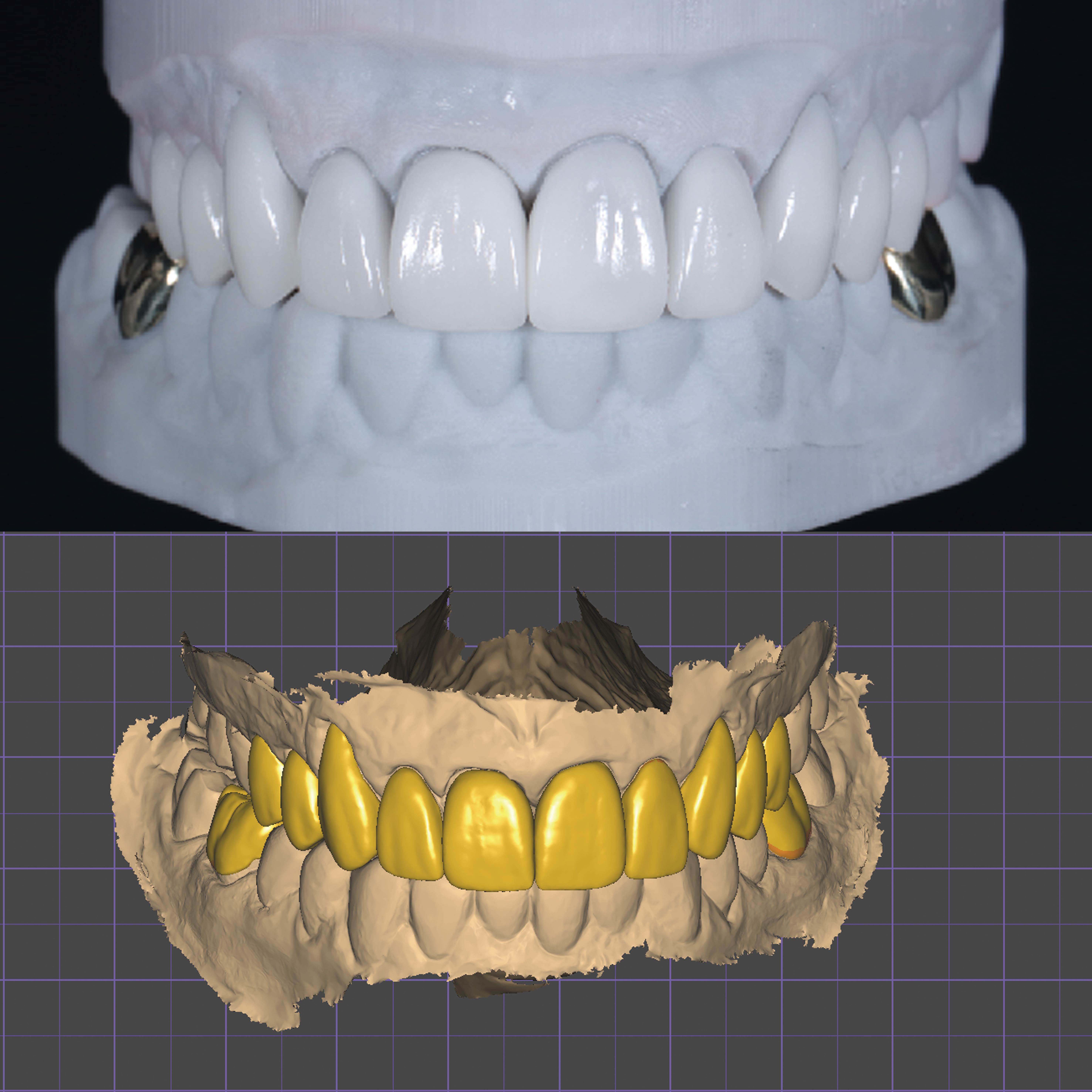 Latest company case about Digital Workflow for Full-Arch Zirconia Bridge with Implant-Supported Restorations