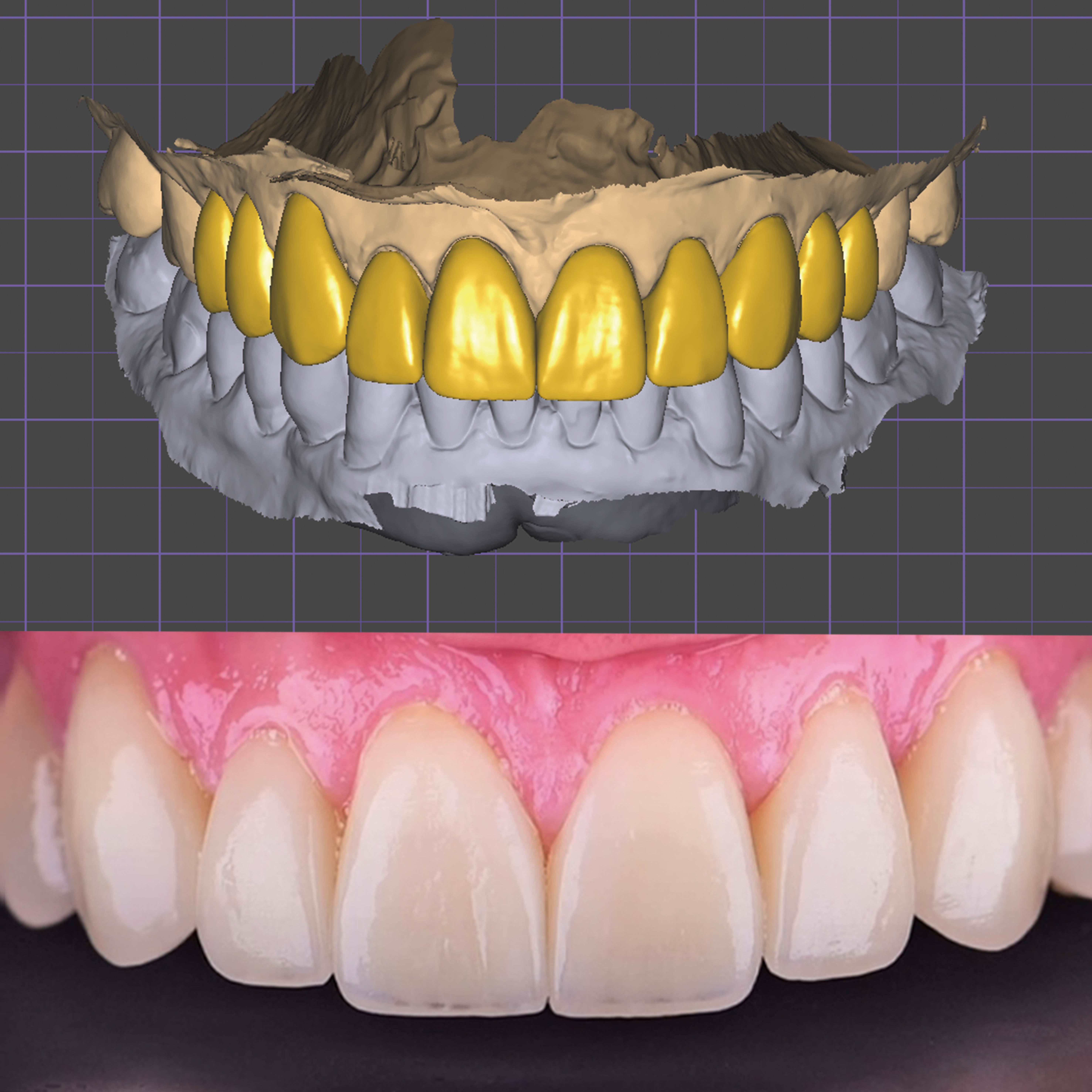 Latest company case about Digital Workflow for Full-Arch Anterior Zirconia Restoration Case Study