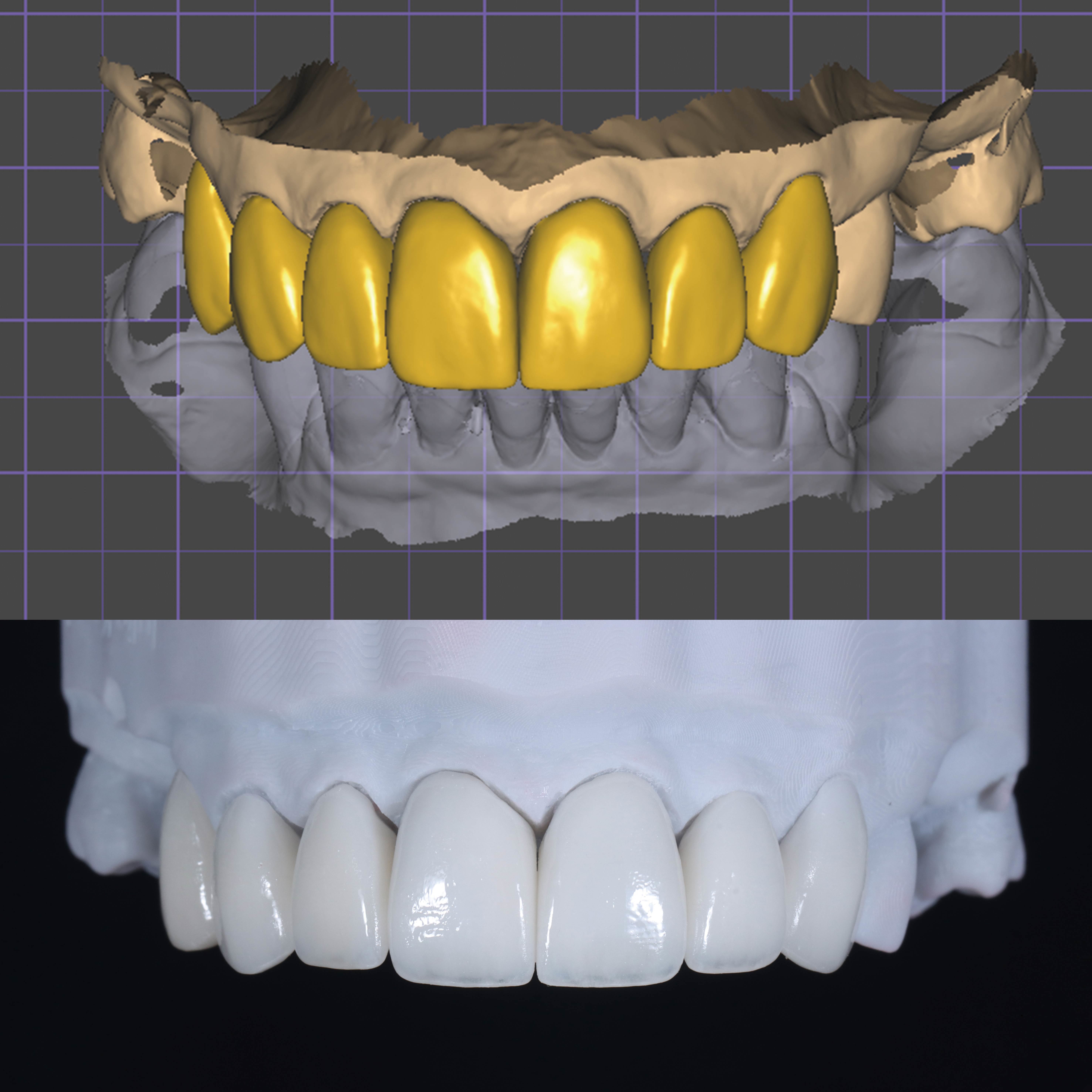Latest company case about Digital Workflow for Anterior Zirconia Fixed Bridge Restoration Case Study