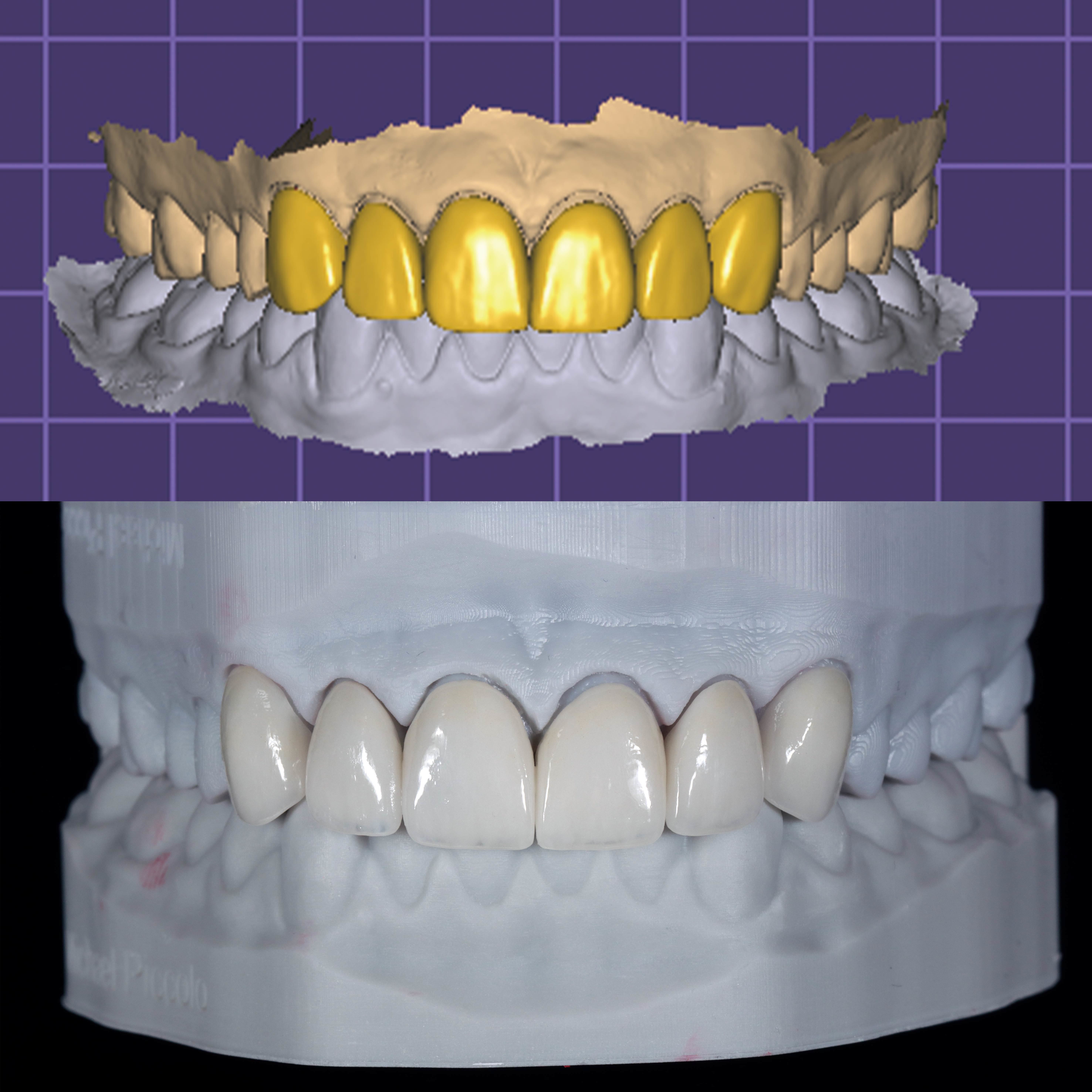 Latest company case about Digital Smile Design & Minimally Invasive Porcelain Veneer Restoration Case Study