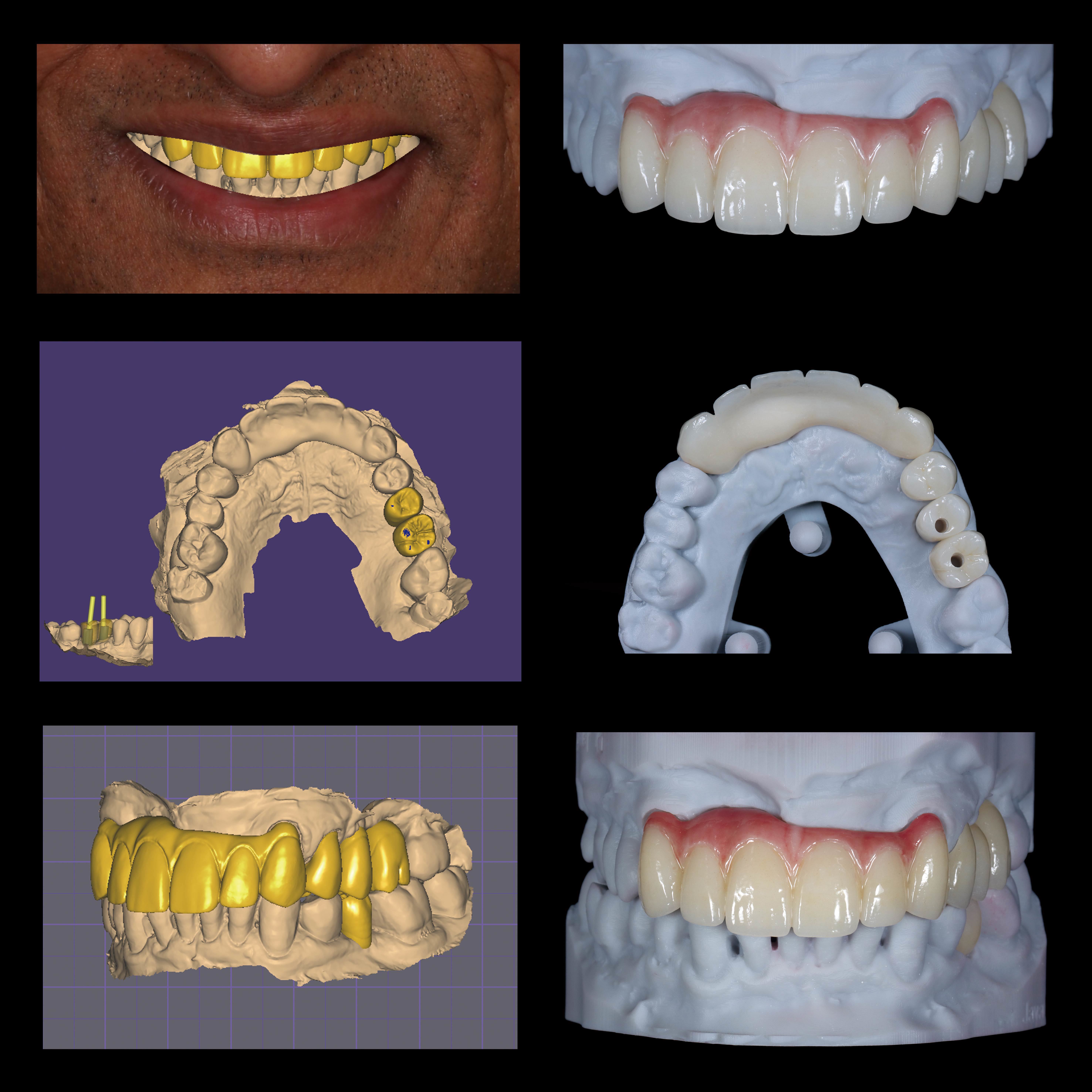 Latest company case about Digital Implant Planning & Multi-unit Zirconia Bridge Restoration Case Study