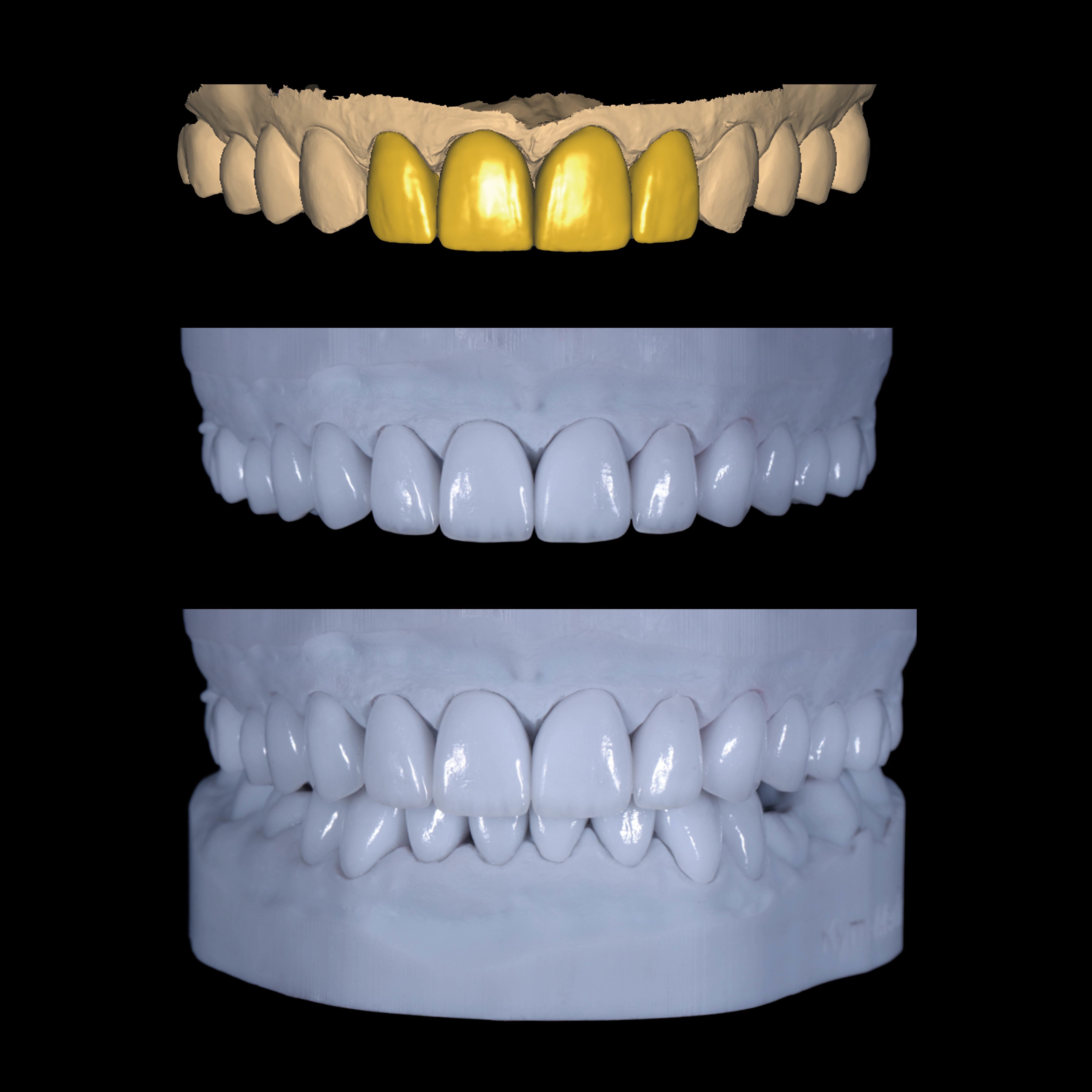 Latest company case about Digital Workflow for Full-Arch Porcelain Veneer & Crown Restoration Case Study