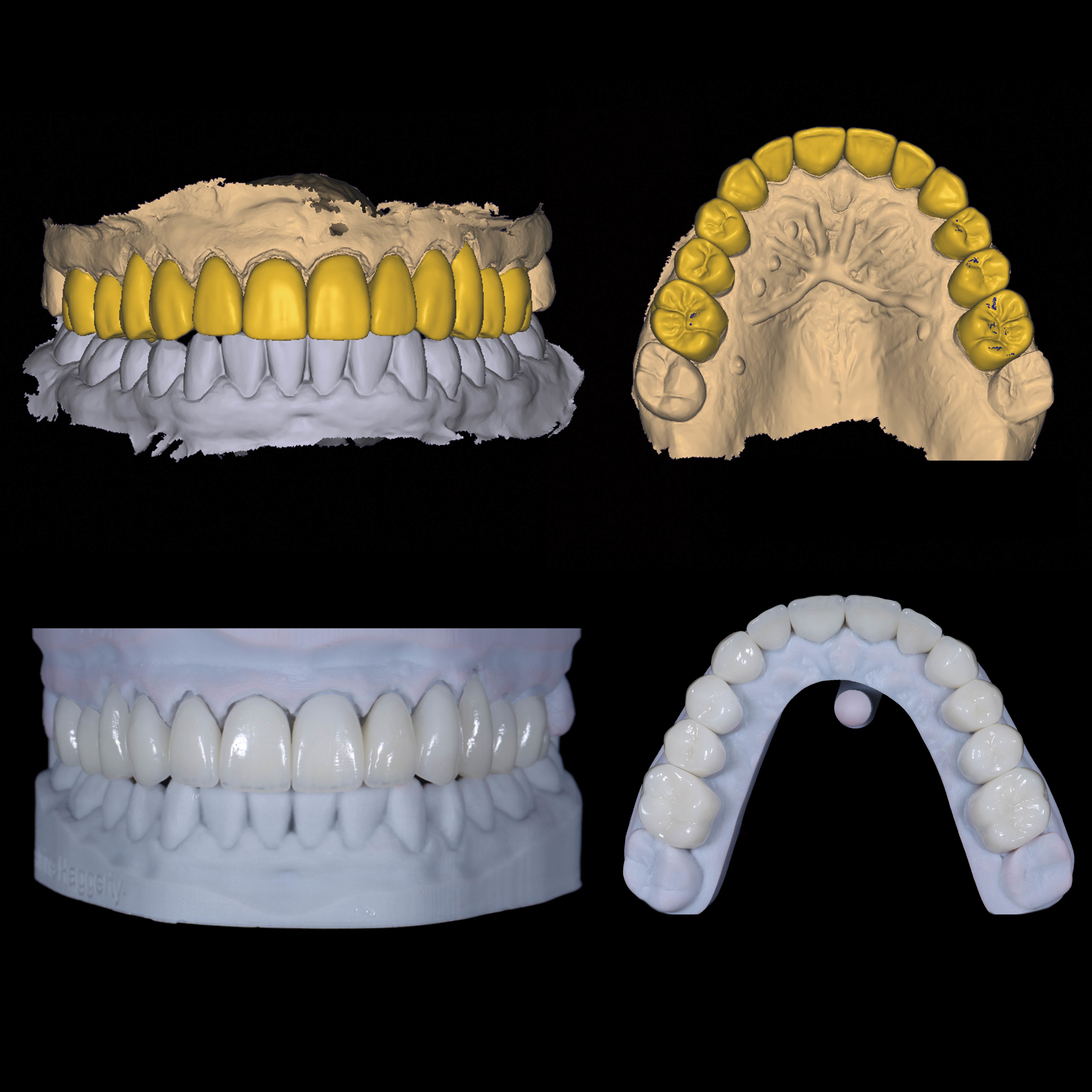 Latest company case about Full-Arch Digital Design & Zirconia Restorative Case Study