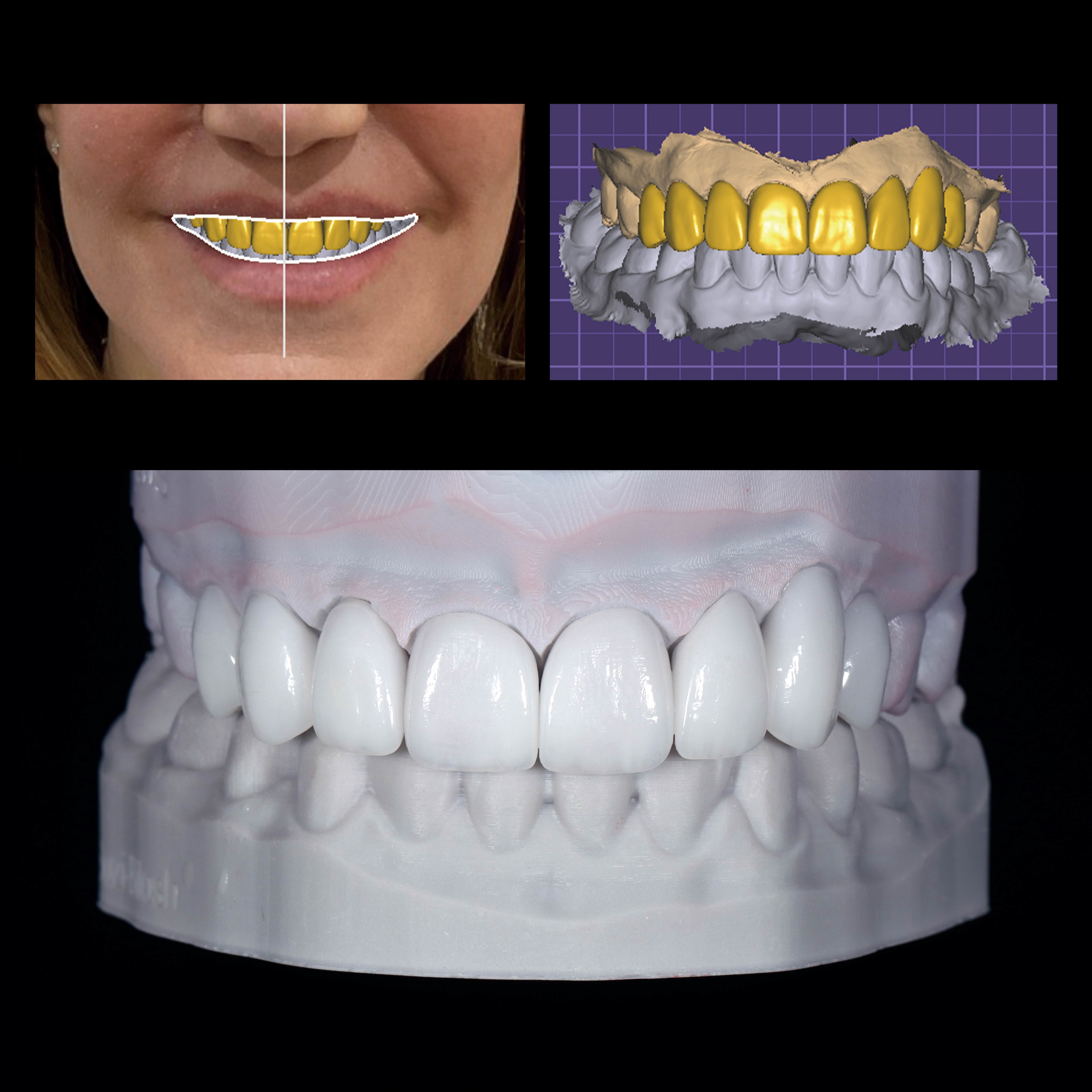 Latest company case about Digital Smile Design (DSD) Guided Anterior Zirconia Veneer Restoration Case Study