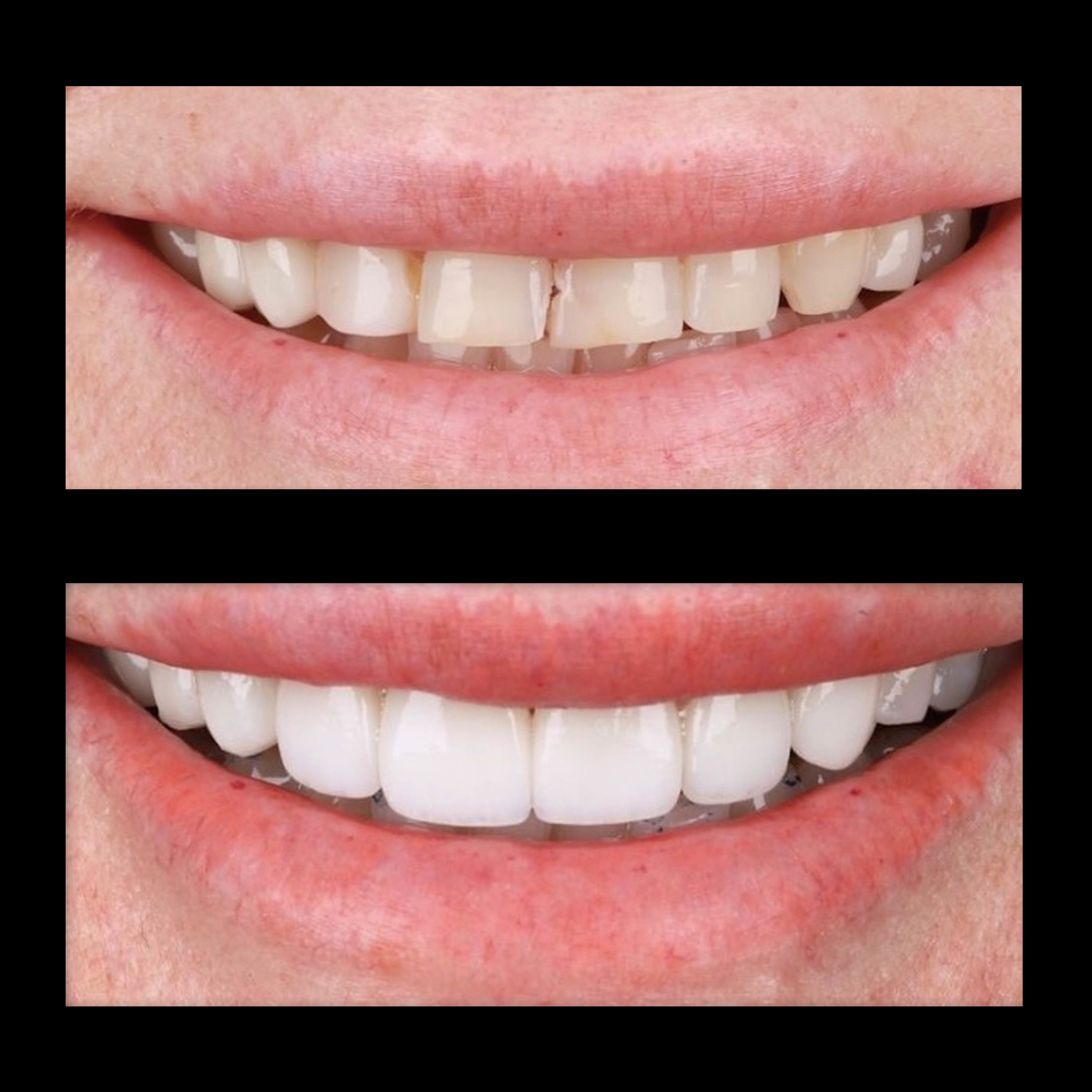 Latest company case about Minimally Invasive Porcelain Veneer Restoration for Anterior Aesthetic Enhancement Case Study