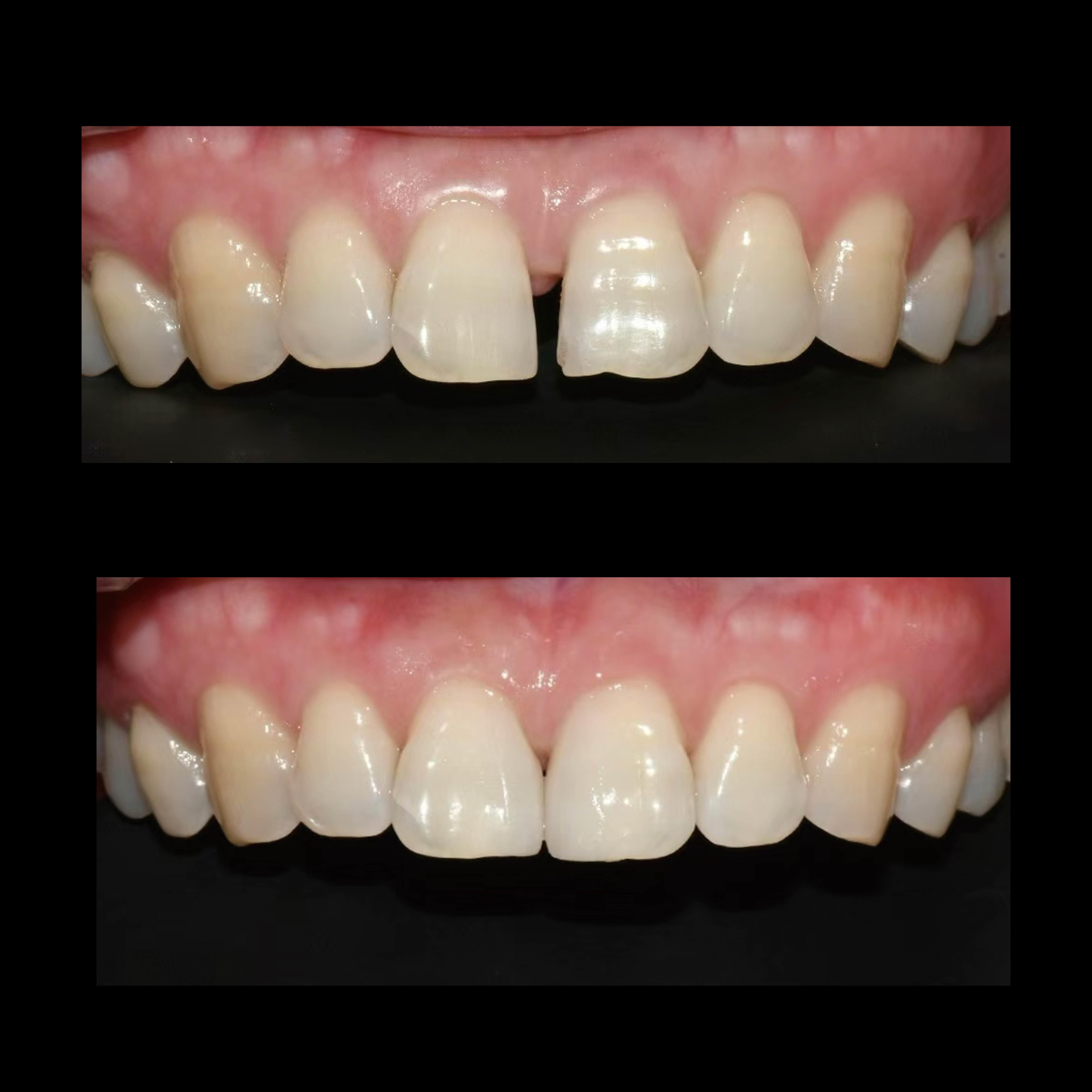Latest company case about Anterior Tooth Reconstruction with Custom Zirconia Crown & Veneer Restoration Case Study