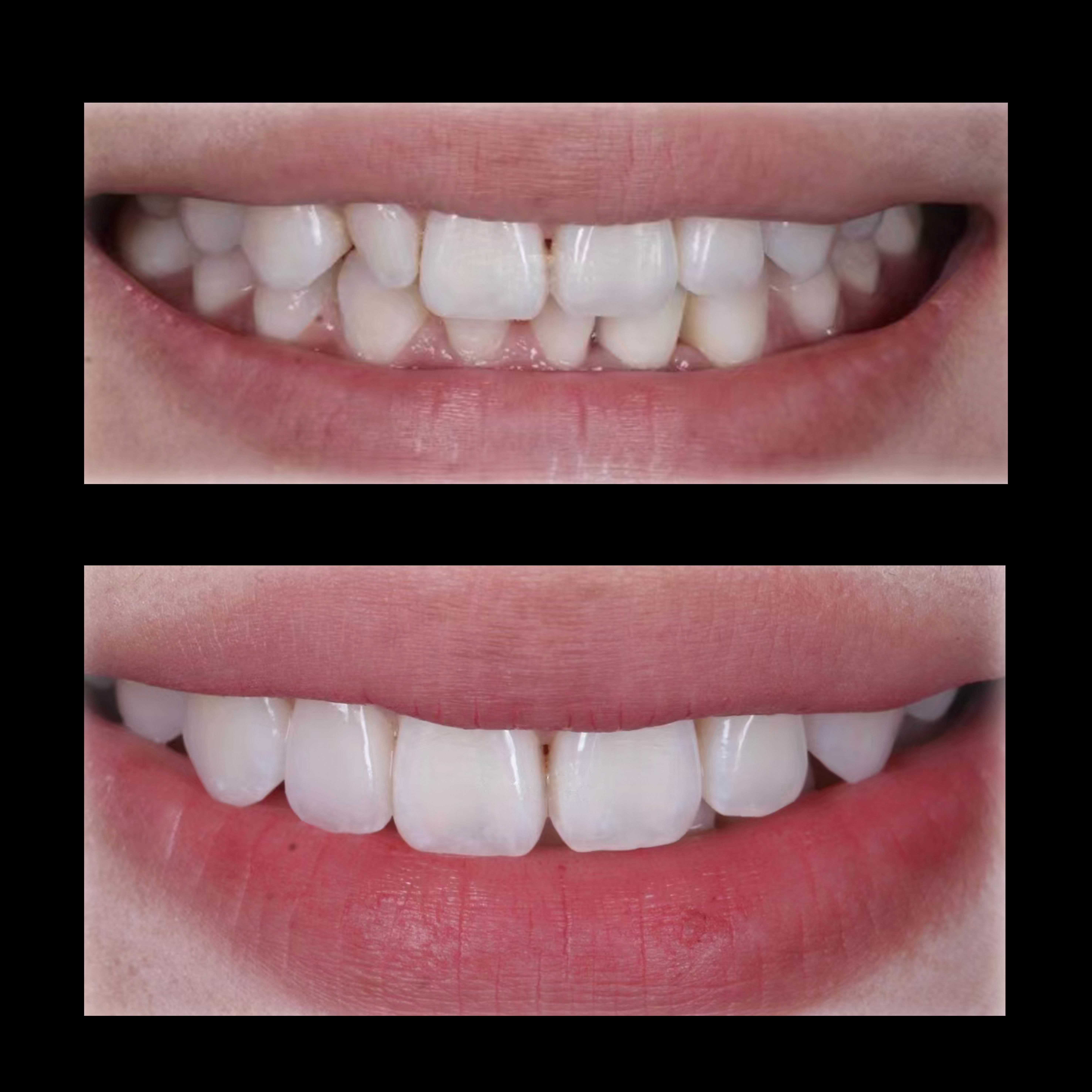 Latest company case about Minimally Invasive Aesthetic Dentistry: Harmonizing Teeth and Smile
