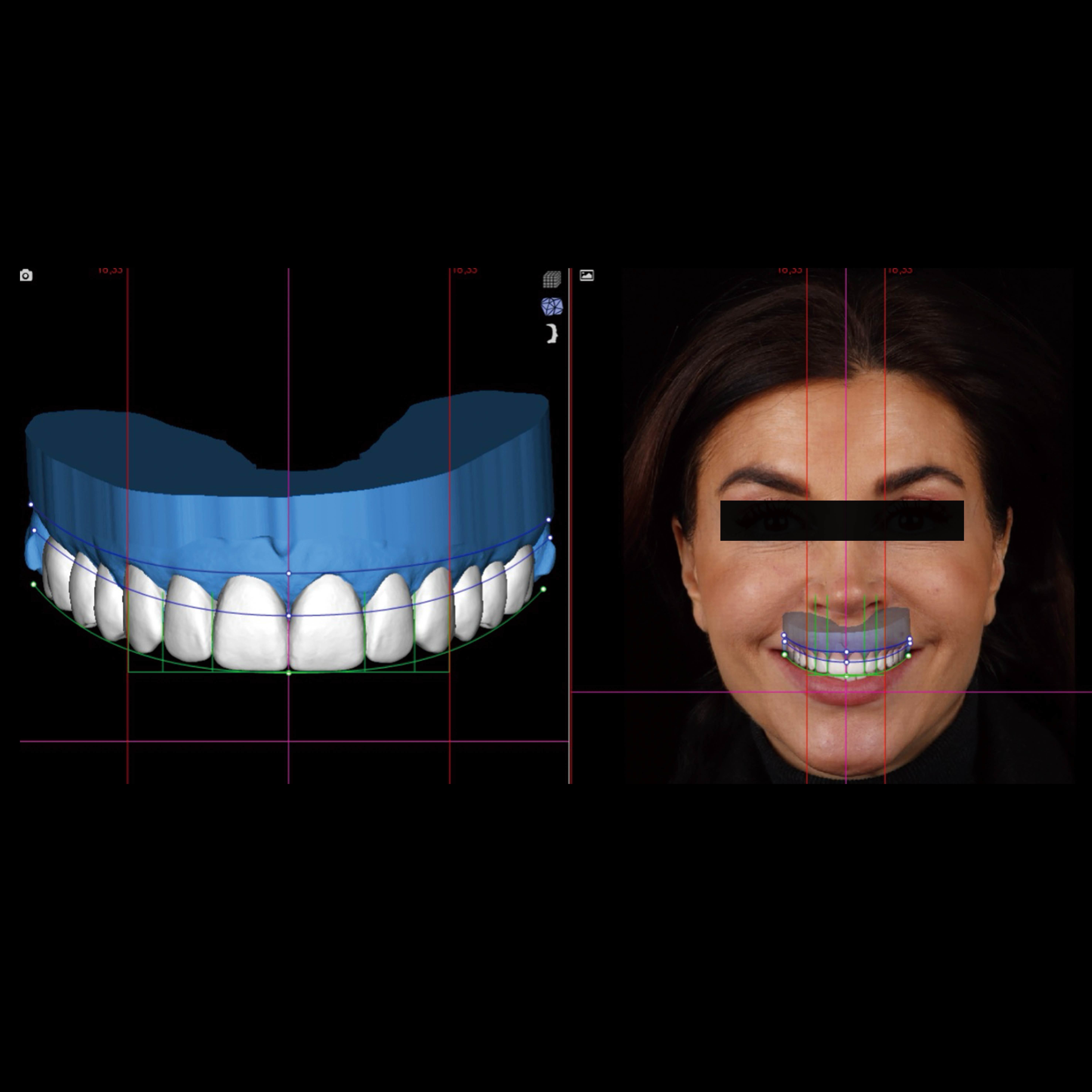 Latest company case about Digital DSD Smile Design + All-Ceramic Restoration