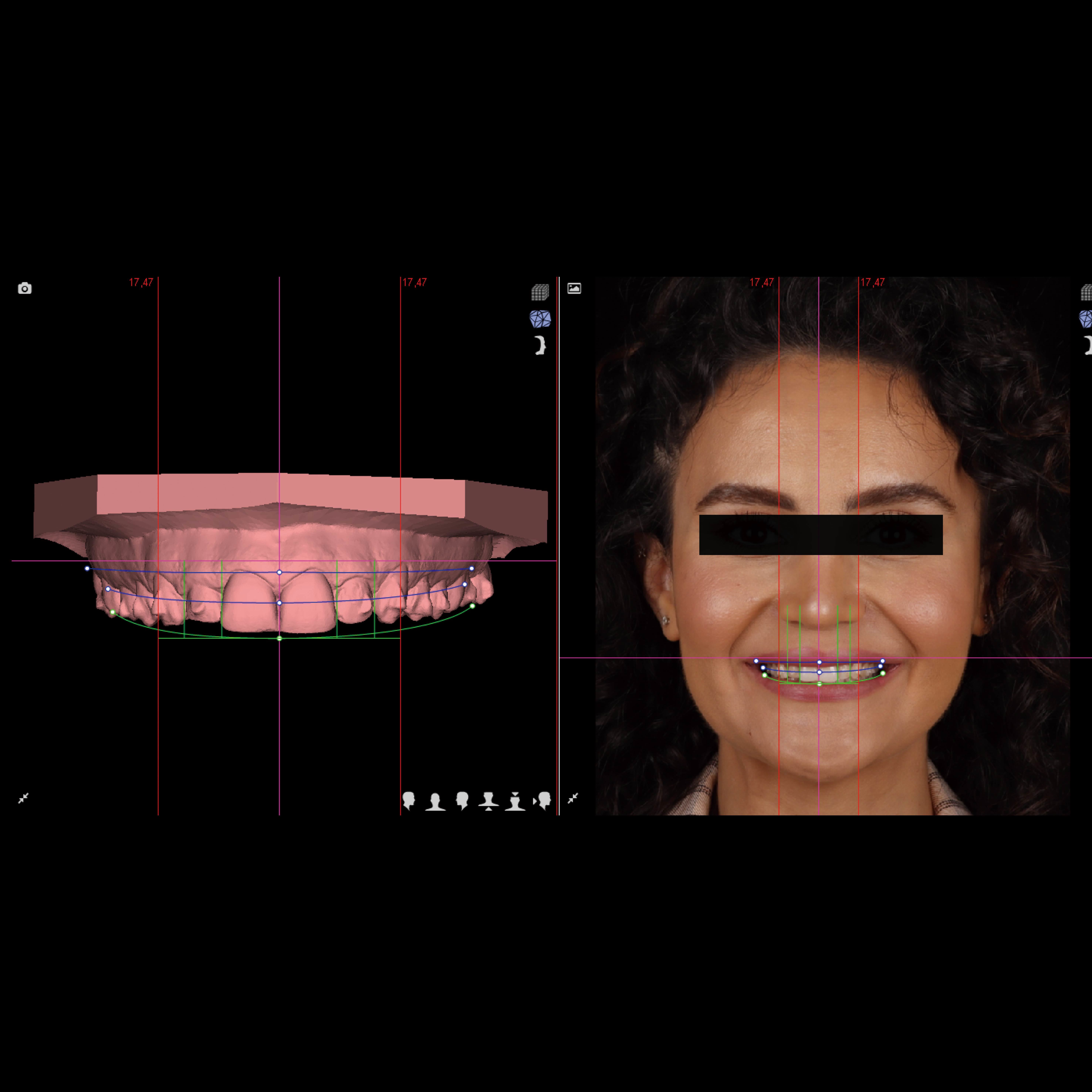 Latest company case about Case Study: Digital DSD Smile Design + Anterior All-Ceramic Aesthetic Restoration