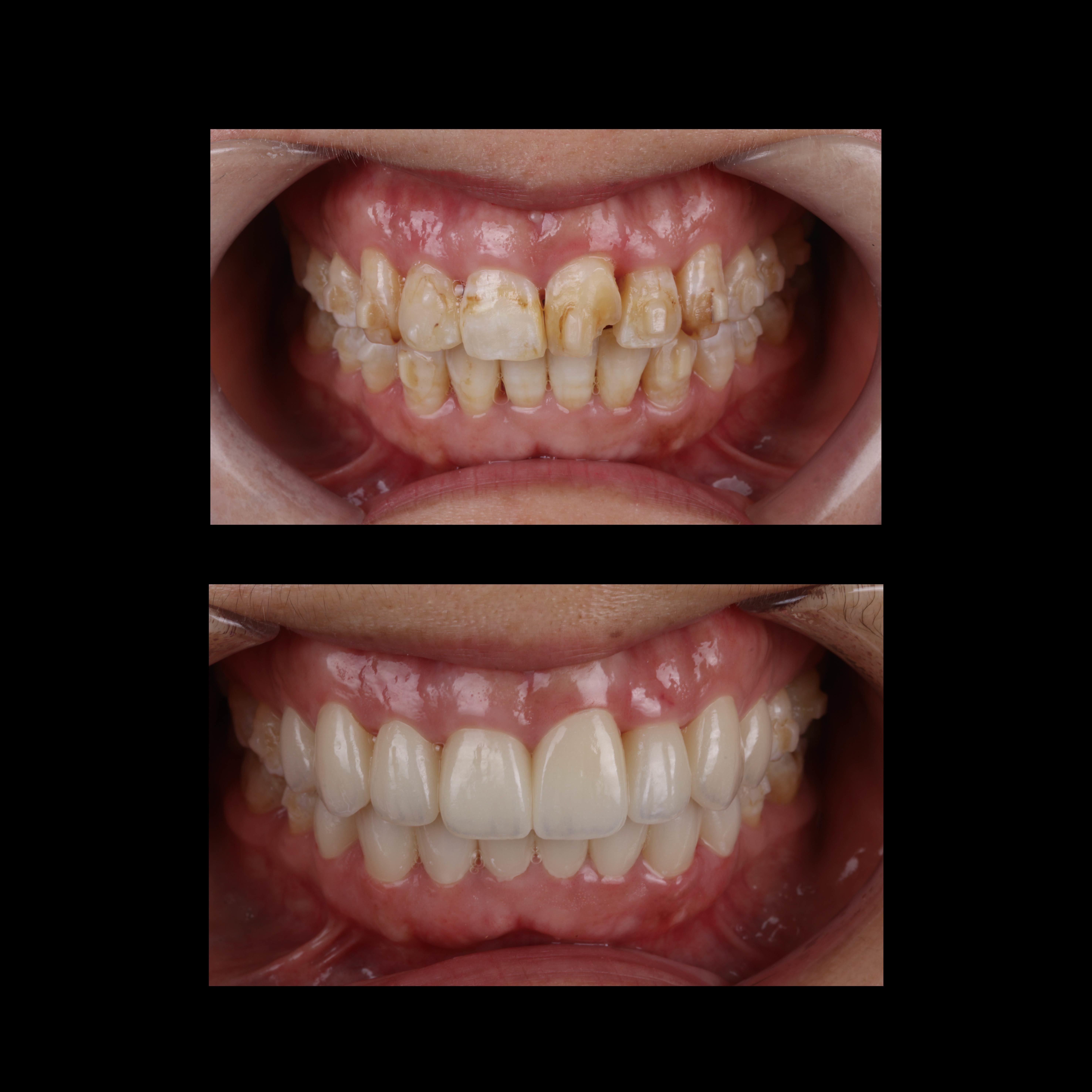 Latest company case about Anterior All-Ceramic Crown Aesthetic Restoration