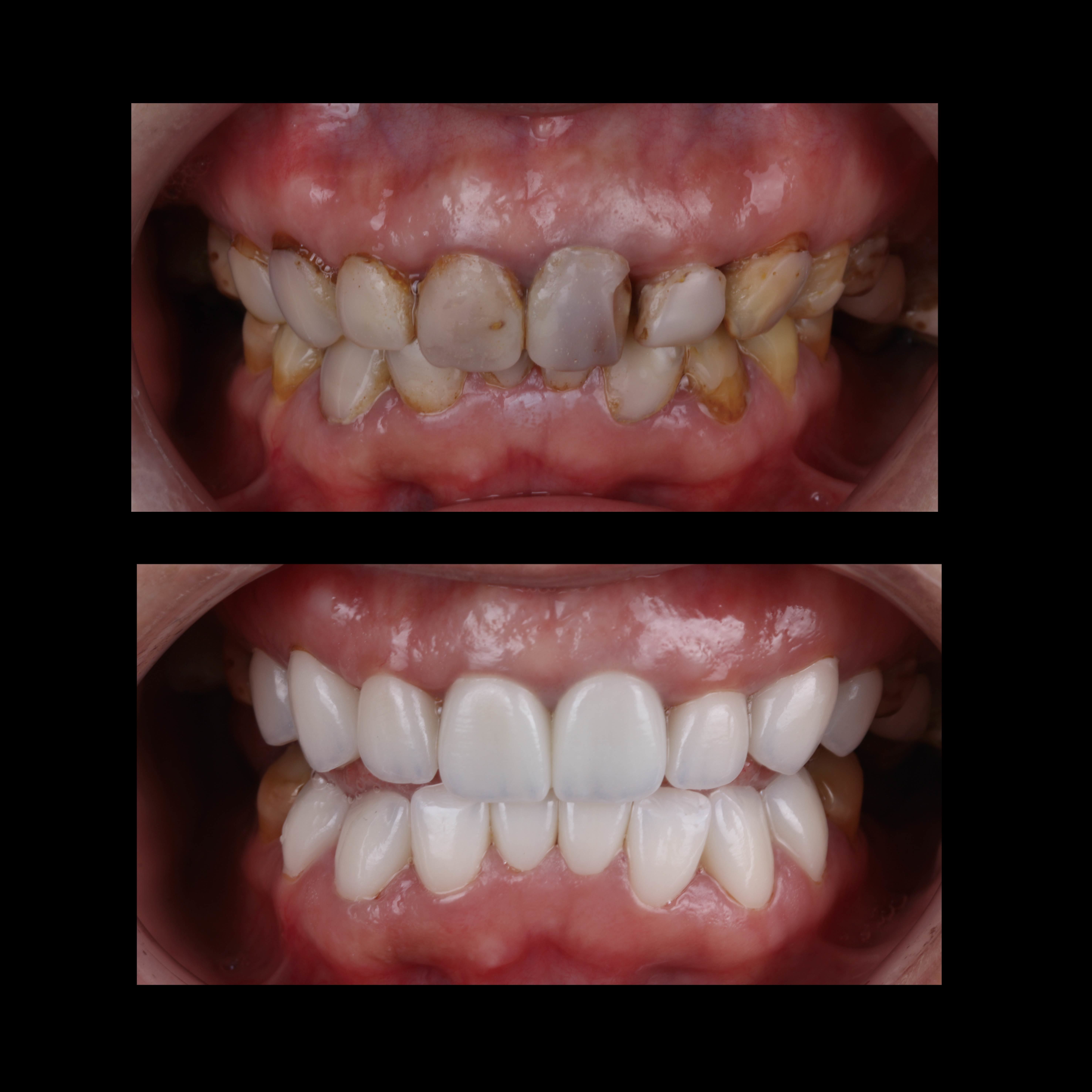 Latest company case about Case Study: Anterior All-Ceramic Crown & Bridge Restoration
