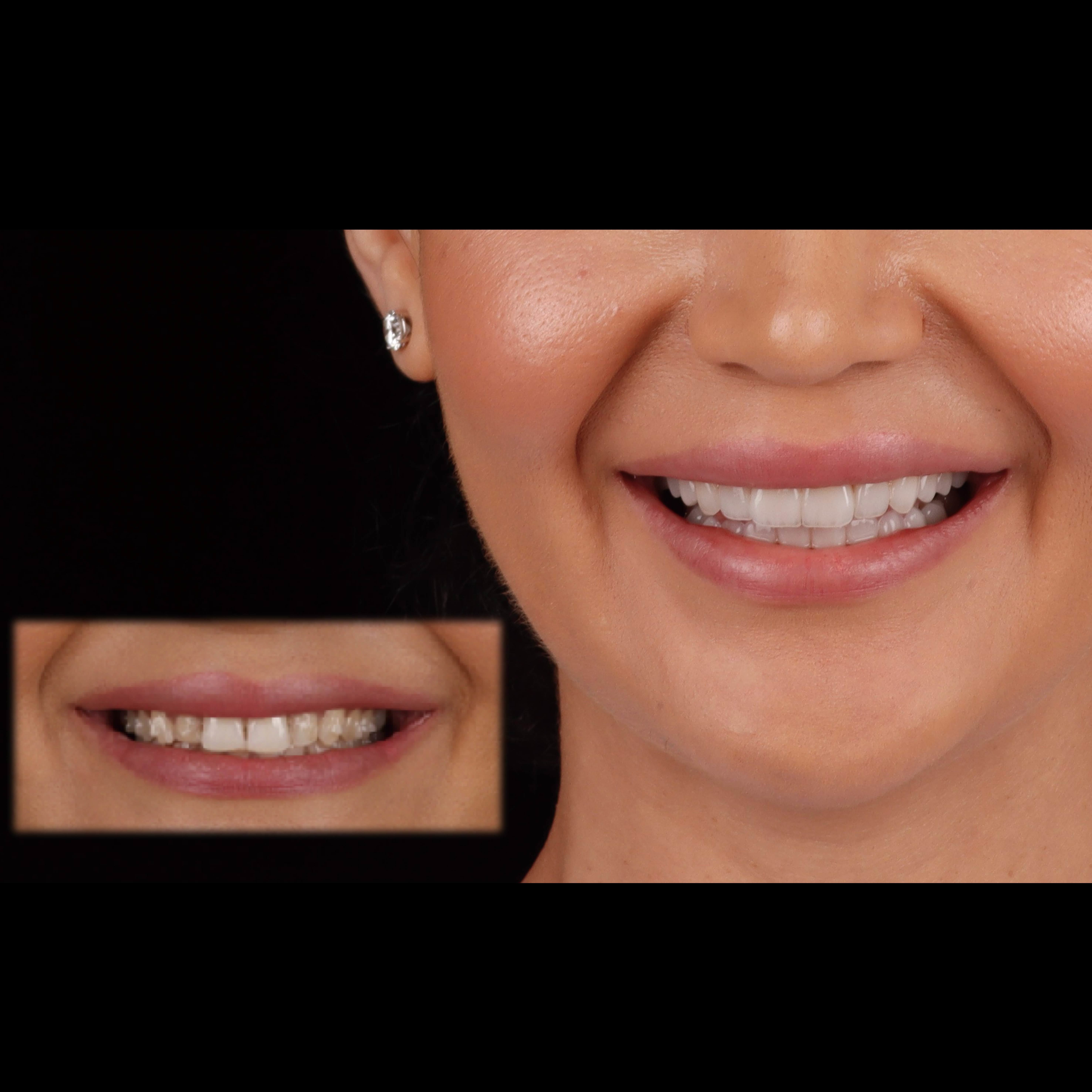 Latest company case about Case Study: Anterior All-Ceramic Veneer Aesthetic Restoration