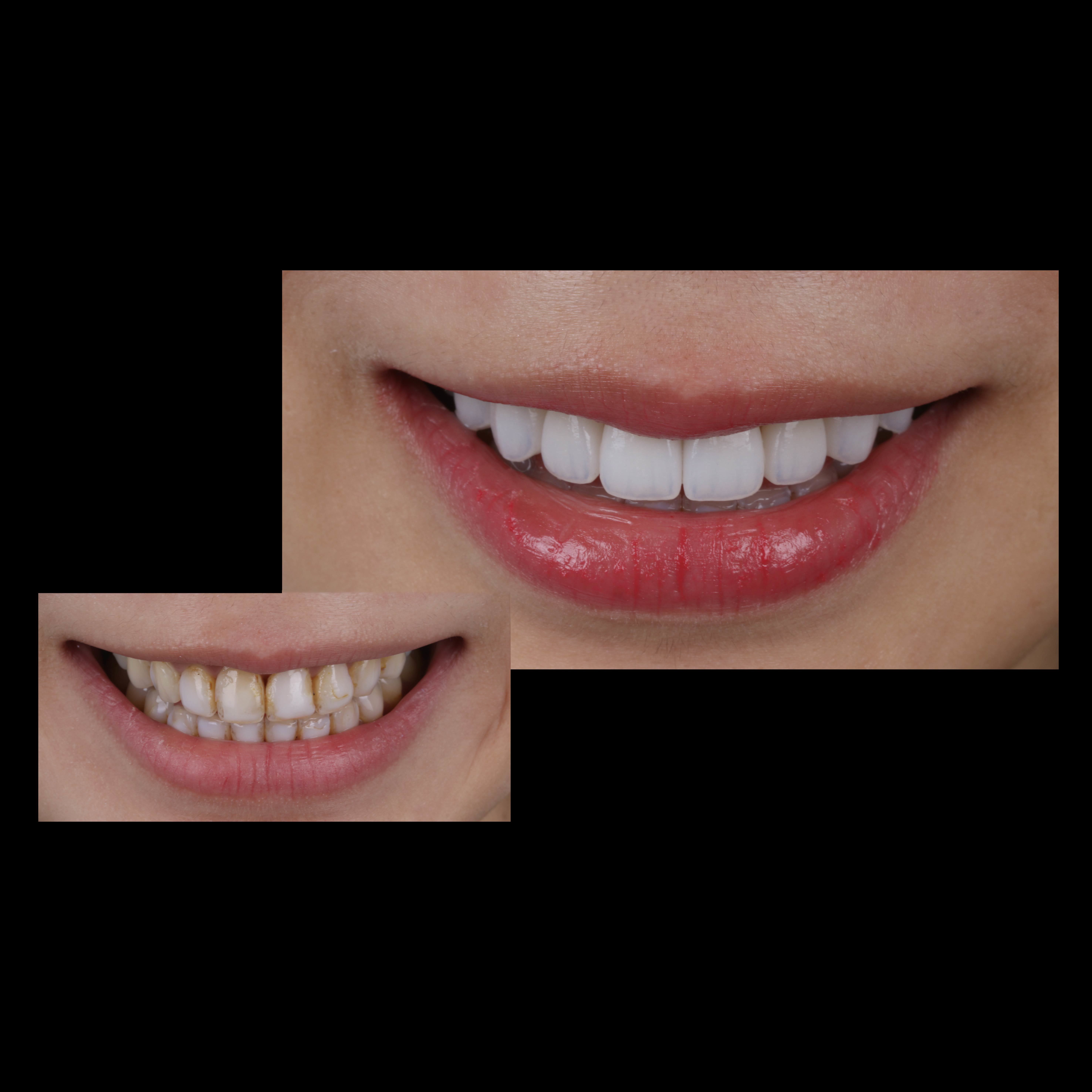 Latest company case about Anterior All-Ceramic Veneer Restoration