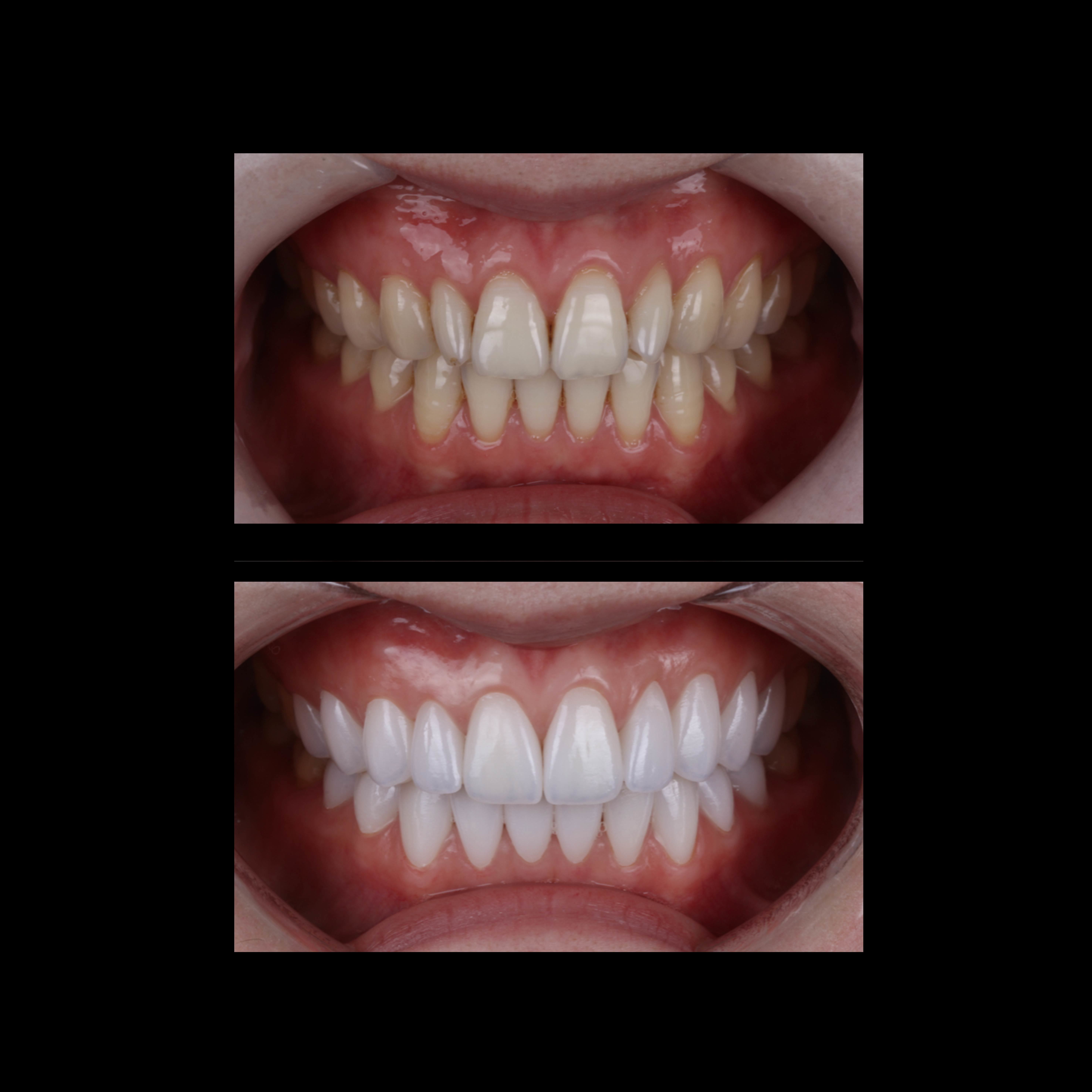 Latest company case about Case Study: Anterior All-Ceramic Crown Aesthetic Restoration
