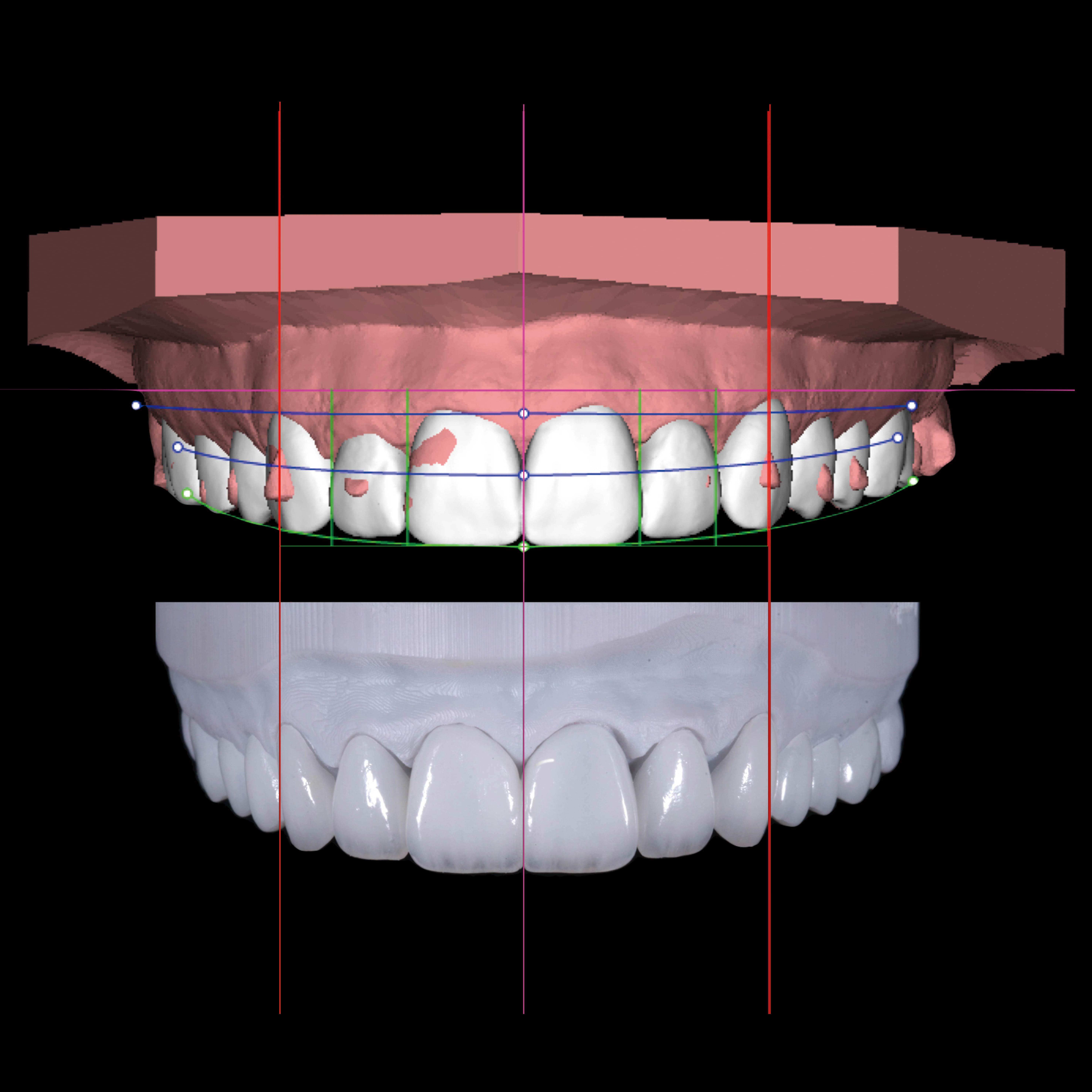 Latest company case about Case Study: Digital All-Ceramic Veneer Aesthetic Restoration